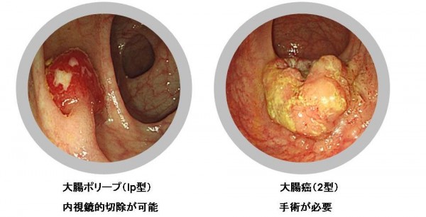 視 鏡 内 検査 大腸