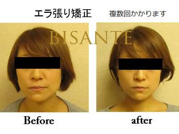顔の歪みが気になる方に 小顔矯正 輪郭矯正 エラ張り矯正 美 サンテ 顔の歪みが気になる方に 小顔矯正 輪郭矯正 エラ張り矯正 美 サンテ